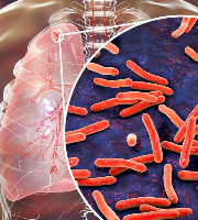 Dlaczego cukrzyca typu 2 zwiększa ryzyko gruźlicy? Poznaj mechanizmy